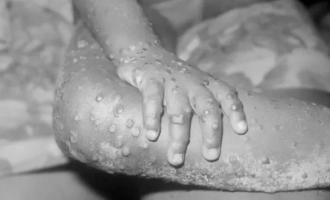  Lumière sur les modes de transmission, symptômes et prise en charge médicale de la variole du singe