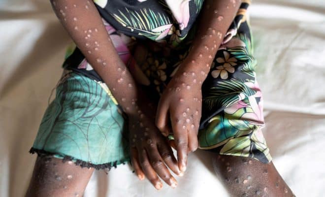  Un cas Variole de singe ou Mpox détecté dans le Golfe, le gouvernement appelle à la vigilance